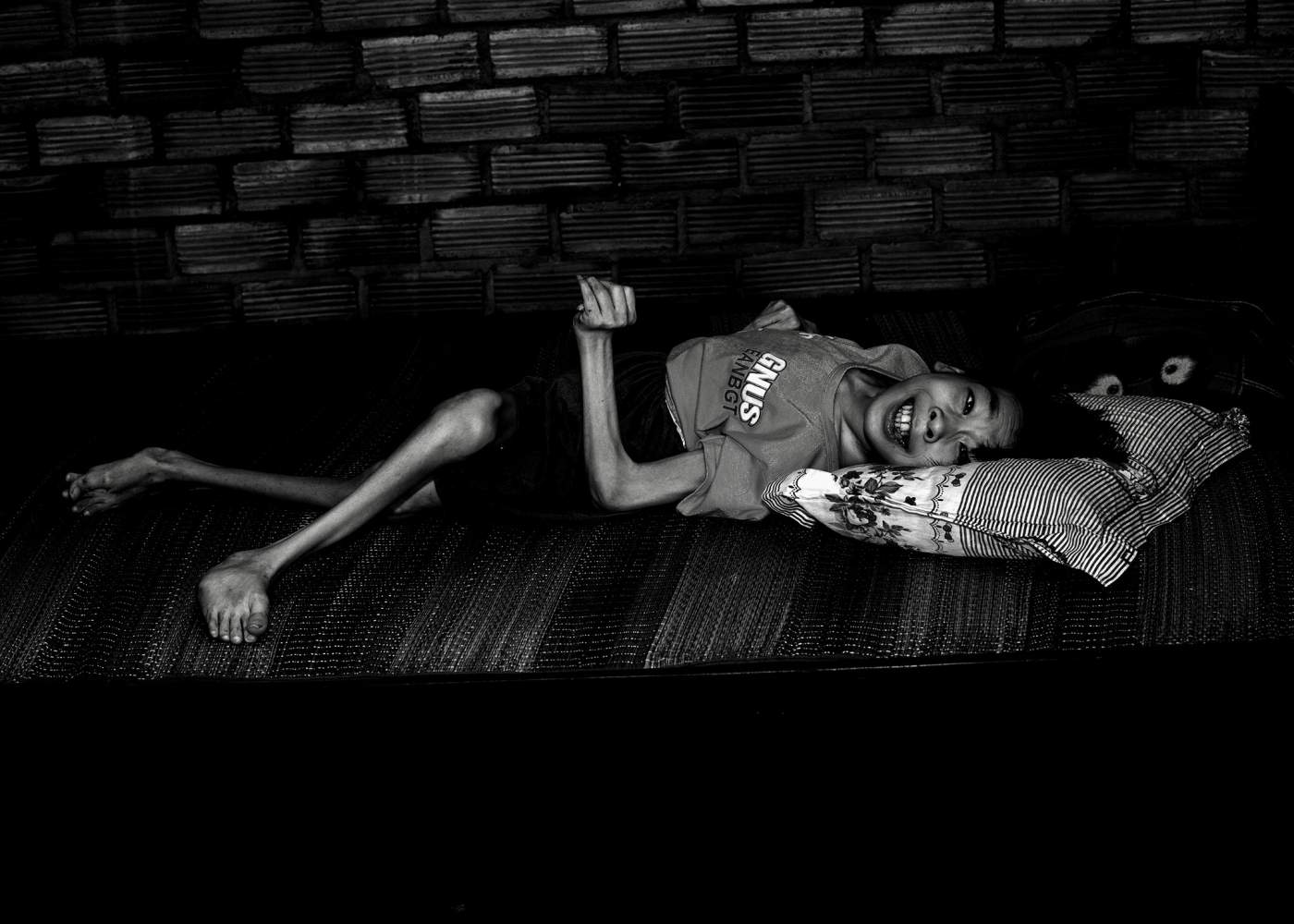 A child severely disabled from Agent Orange